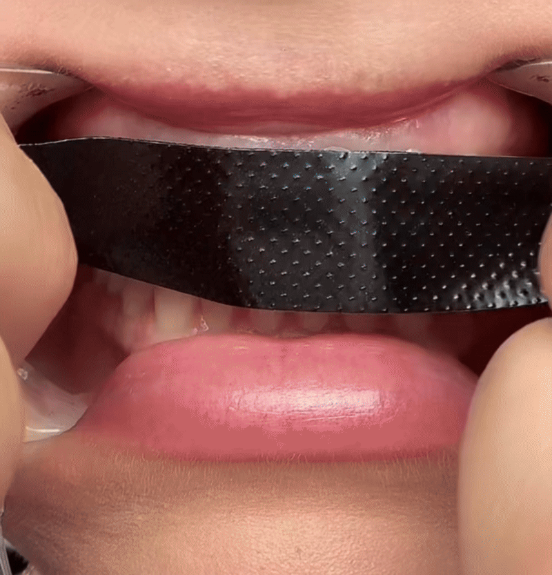 Vorher Nachher Ergebnis Aktivkohlezahnstreifen. Die zähne waren leicht gelb und werden nach der anwendung weiß