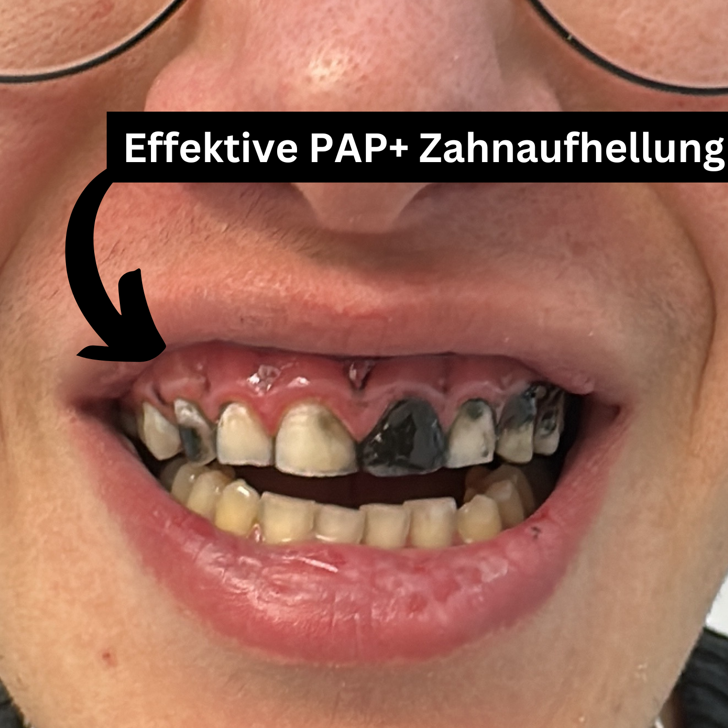 Weiße Zähne nach der Anwendung von PAP+ Aktivkohlezahnstreifen von Puremysmile