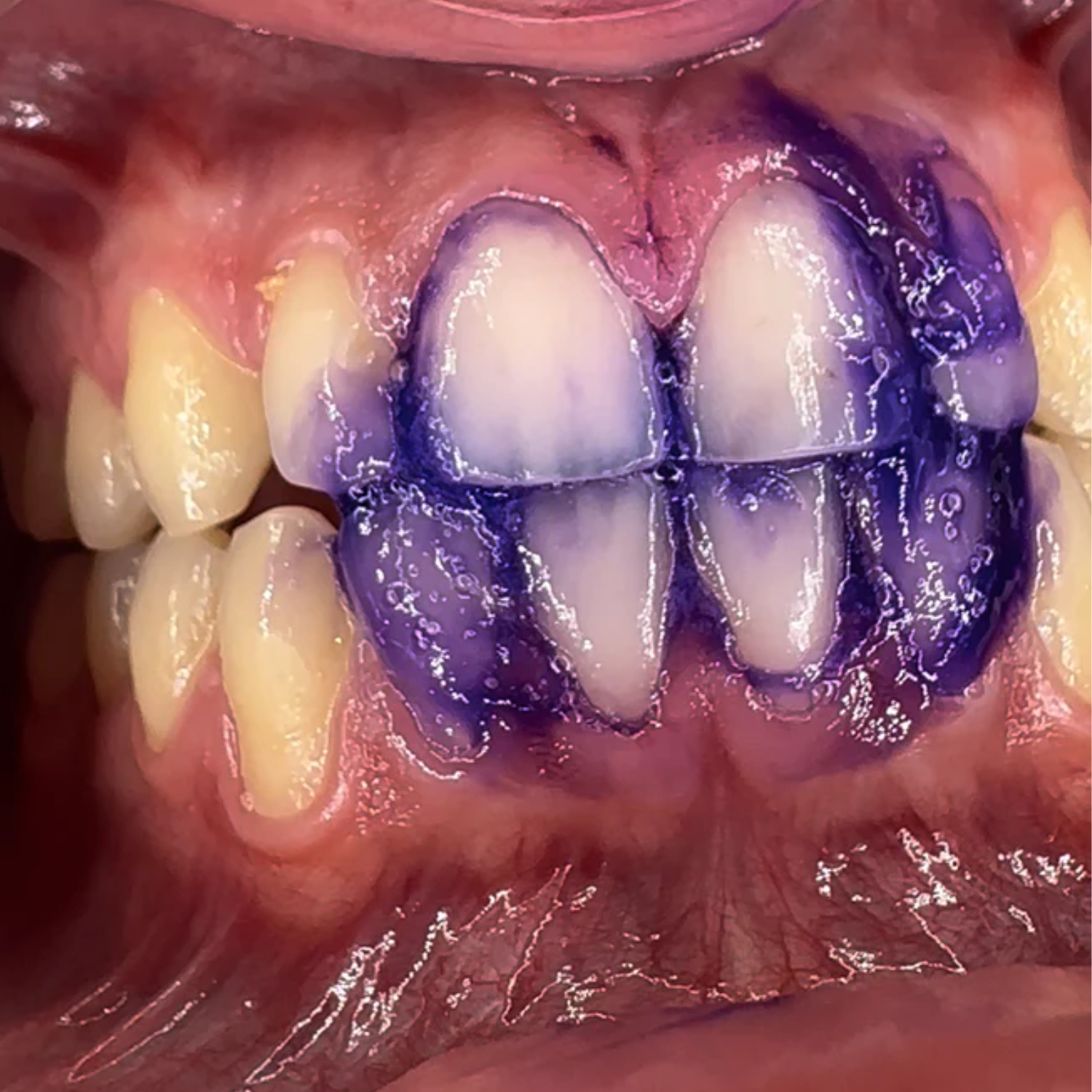 Zähne nach der Anwendung vom Farbkorrekturserum von Puremysmile für kosmetische Zahnaufhellung durch Farbkomplimentärkontrast