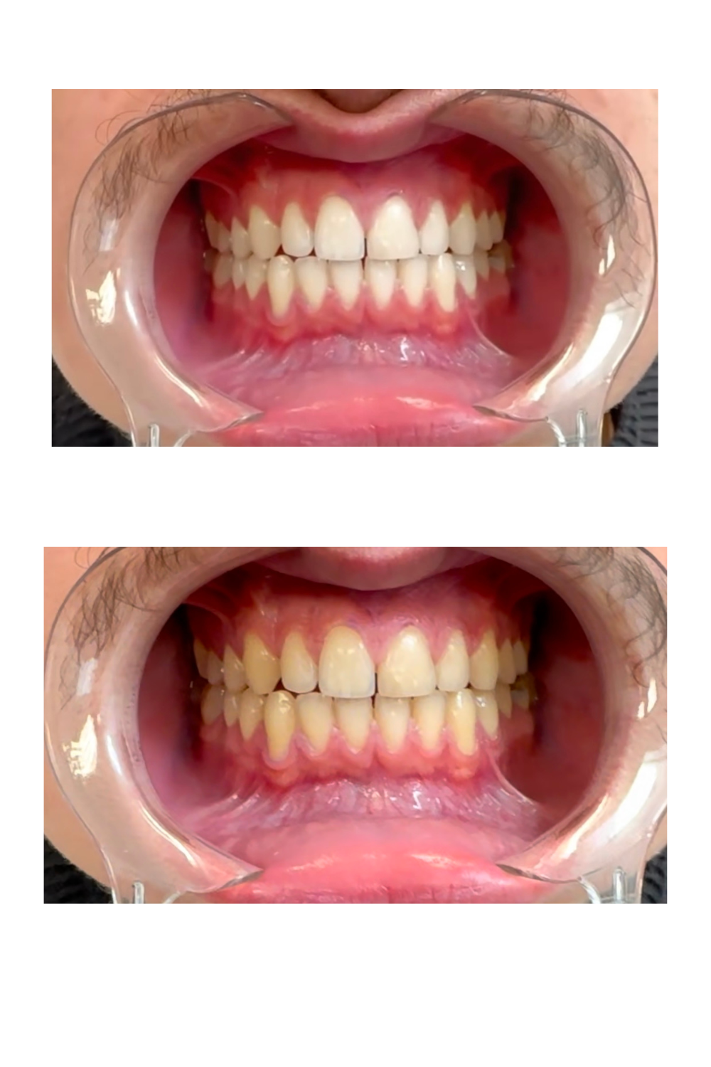 Zähne vorher gelb und nachher weiß