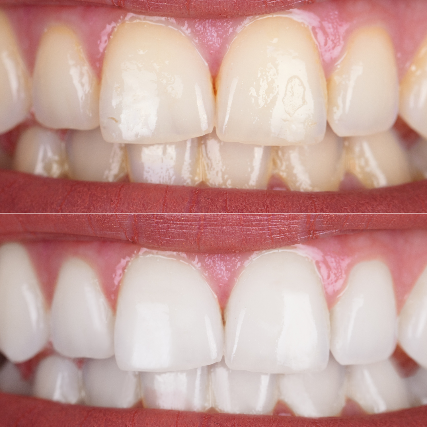 Zähne vorher gelb, nachher weiß