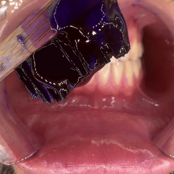 Farbkorrekturserum von Puremysmile zum Zähneputzen anwenden mit anschließendem Abwischen zum zeigen der kosmetischen Aufhellung durch Farbkomplimentärkontrast von violetttem Serum auf gelbstichen an den Zähnen