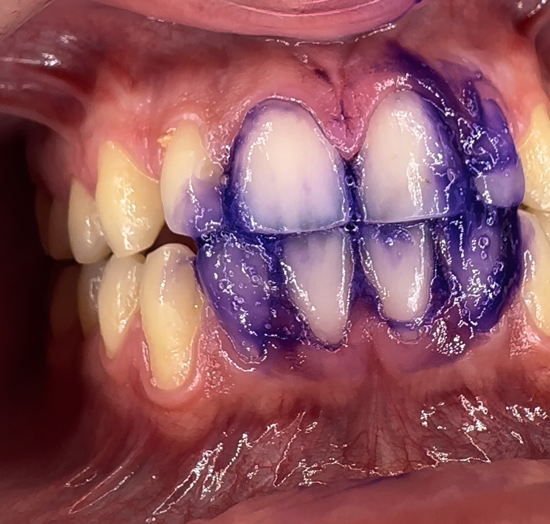Farbkorrekturserum von Puremysmile zum Zähneputzen anwenden mit  zum zeigen der kosmetischen Aufhellung durch Farbkomplimentärkontrast von violetttem Serum auf gelbstichen an den Zähnen