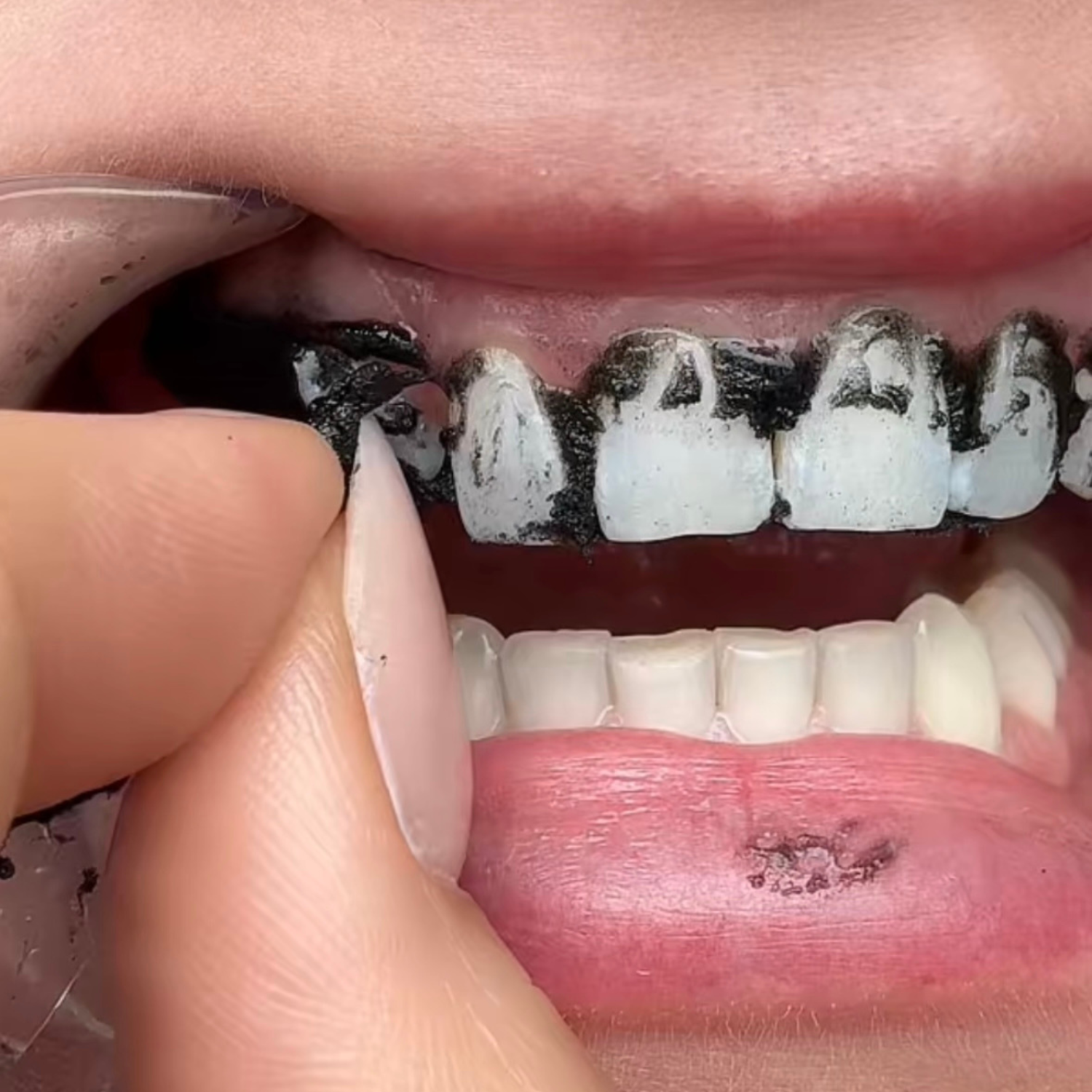 Aktivkohle PAP+ Zahnstreifen vorher nachher Ergebnisse. zähne waren vor der anwendung gelb und sind nachher weiß