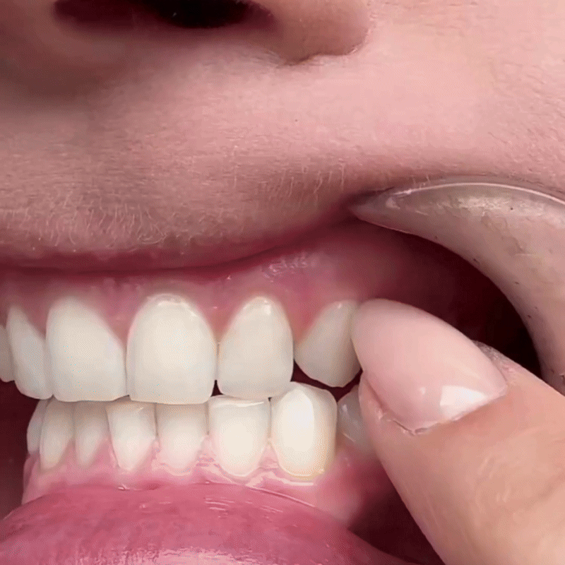 Aktivkohle PAP+ Zahnstreifen vorher nachher Ergebnisse. zähne waren vor der anwendung gelb und sind nachher weiß