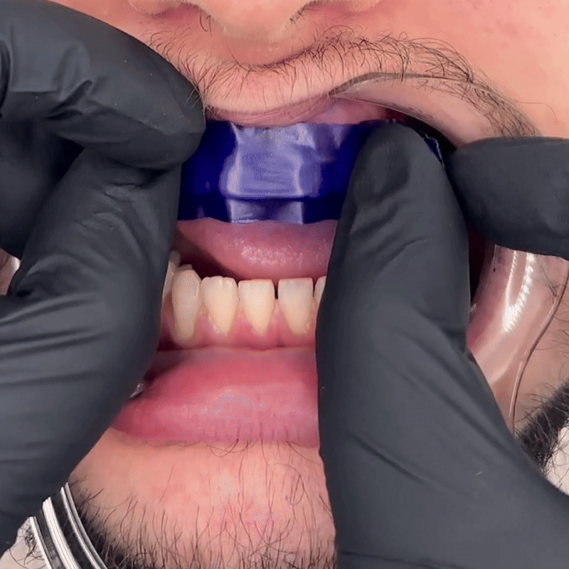 Farbkorrektur - Zahnstreifen